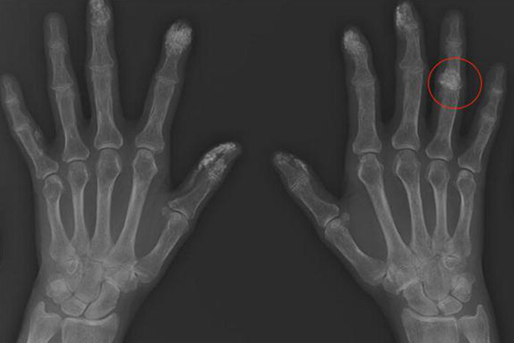 手指关节钙化影像图