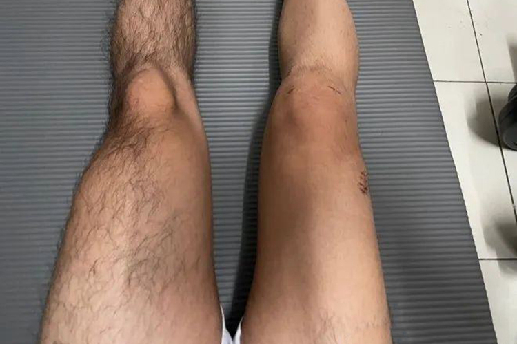 骨关节炎致腿部肌肉萎缩图 骨关节炎致腿部肌肉萎缩图