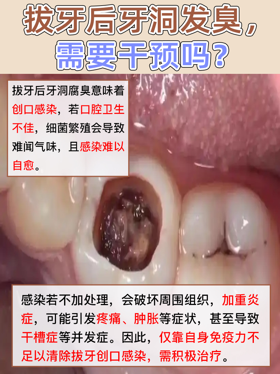 拔牙牙洞异味，等它自然散？