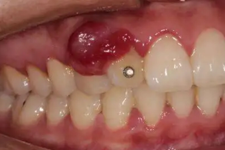 牙龈瘤图 牙龈瘤图