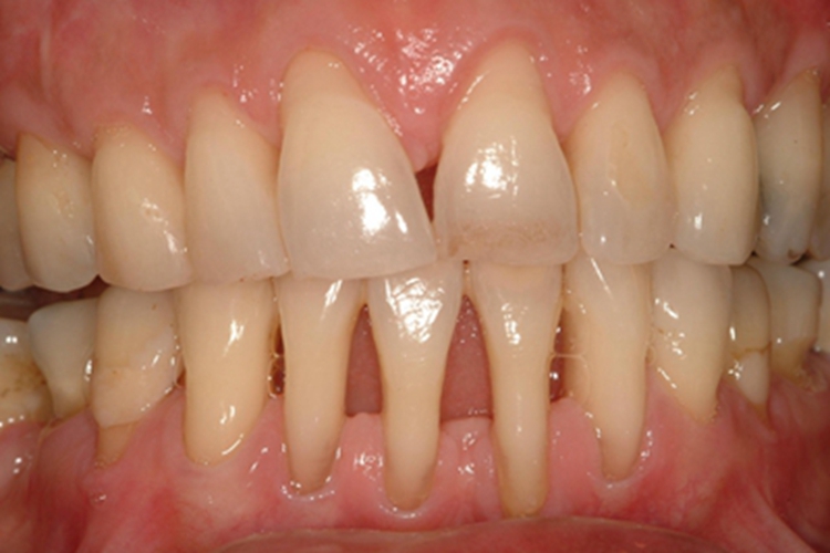 牙龈萎缩露出细长牙根图