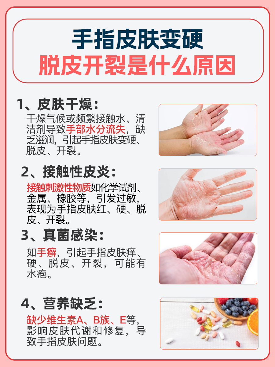 医生解惑：手指皮肤变硬脱皮开裂什么原因？