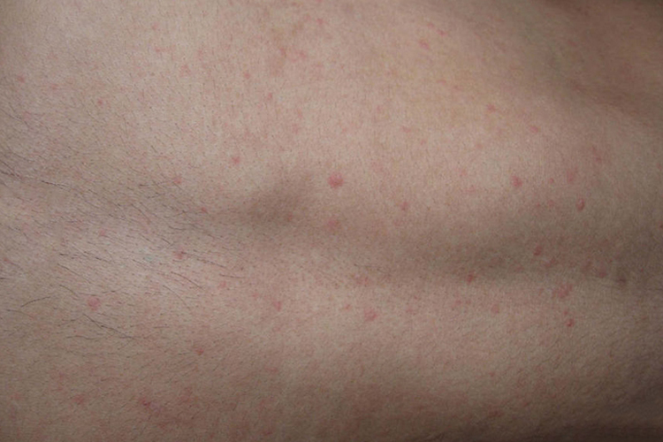 胆碱能性荨麻疹图