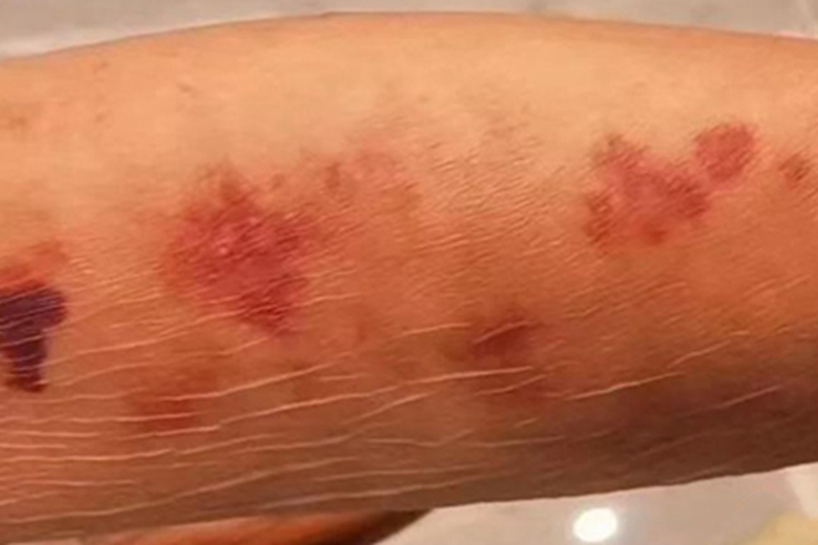 血友病B胳膊症状图
