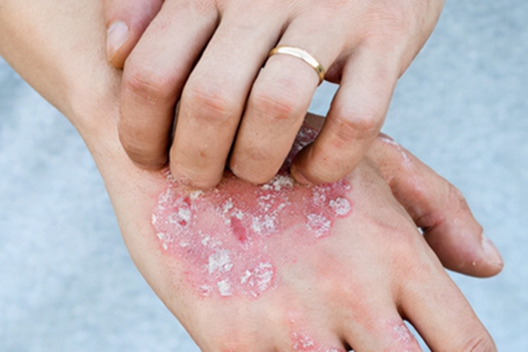 手部湿疹手背红色斑块脱屑图