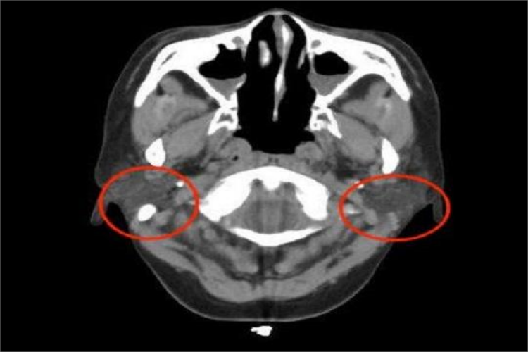 正常颌面部CT腮腺图 正常颌面部CT腮腺图
