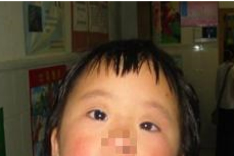 唐氏综合征面部呆滞图