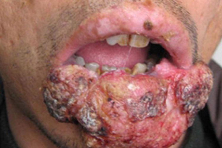 皮肤鳞状细胞癌嘴唇瘤图 皮肤鳞状细胞癌嘴唇瘤图