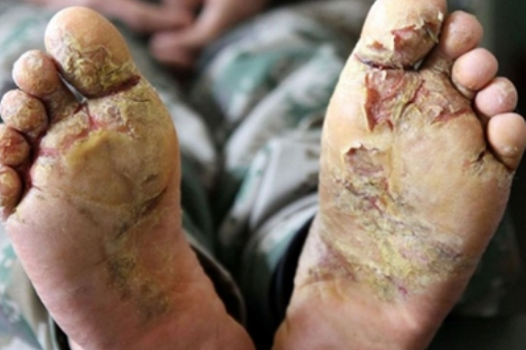 战壕足脚底溃疡图