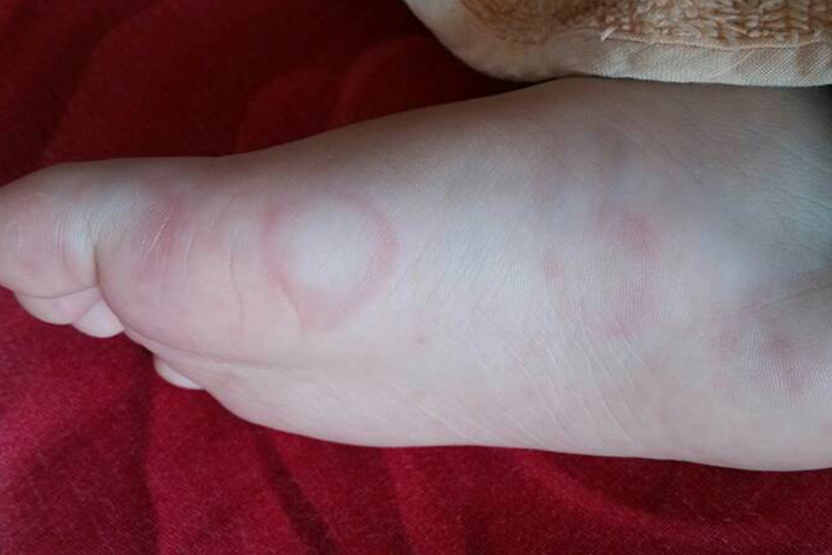 婴儿身上离心性环状红斑图