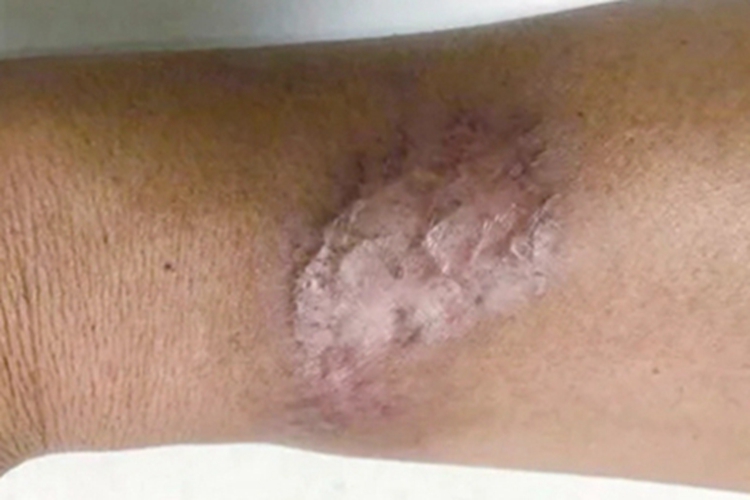 皮肤非典型分枝杆菌病胳膊瘢痕图