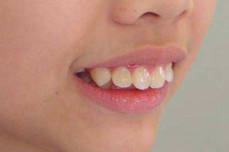 牙性凸嘴图 牙性凸嘴图