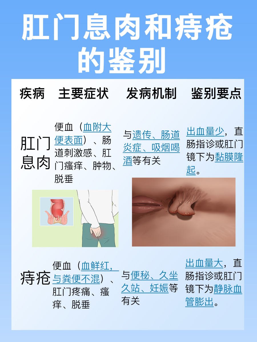 如何区分肛门息肉与痔疮?一文了解