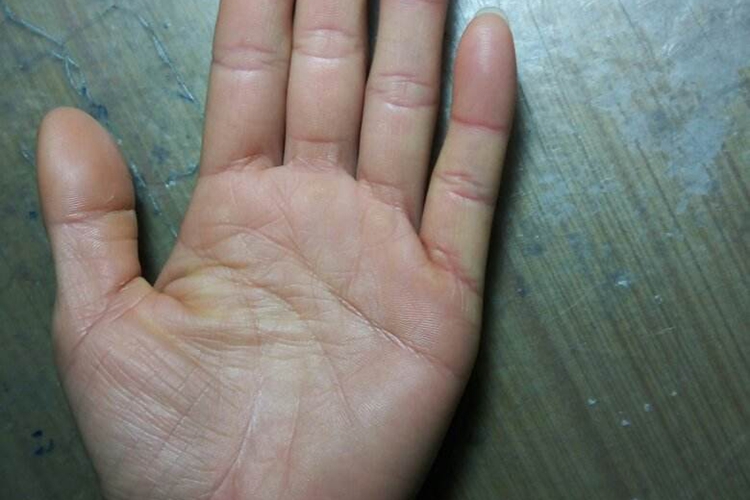 手上色素沉着图