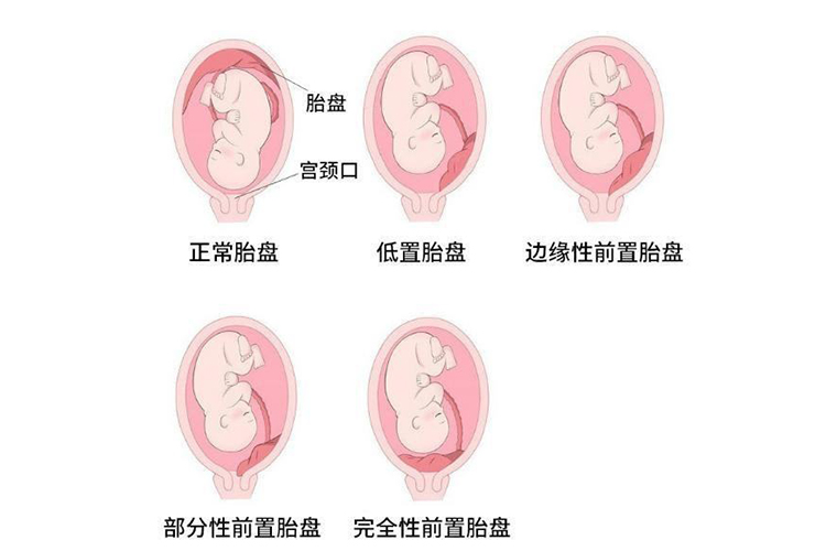 胎盘和子宫关系图