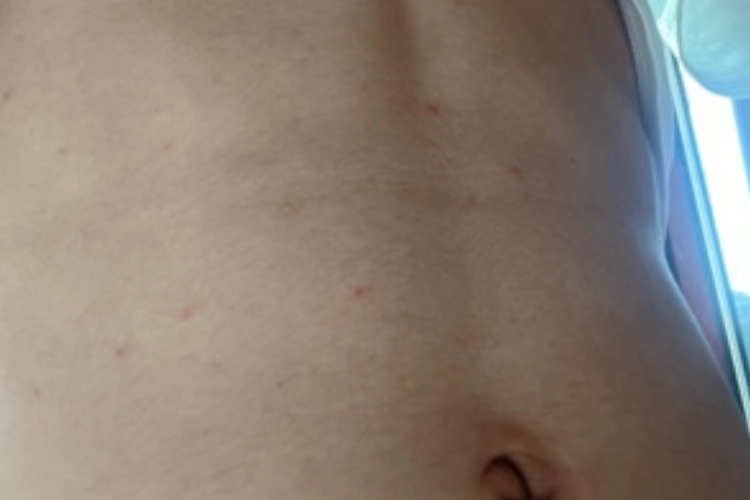 毛囊炎腹部鲜红色丘疹图