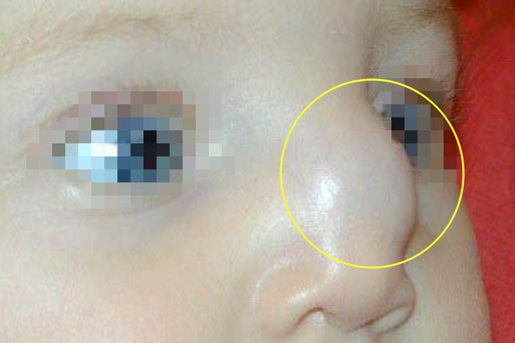 皮样囊肿鼻部肿块图