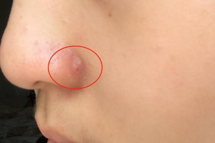 毛囊炎鼻子两侧长小痘痘图