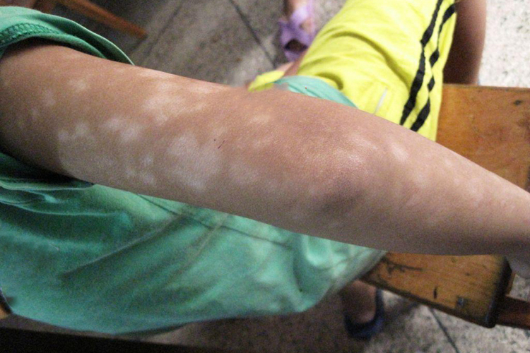 儿童手臂单纯糠疹图 儿童手臂单纯糠疹图