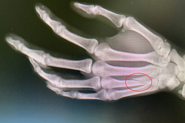 拳击手骨折影像图 拳击手骨折影像图