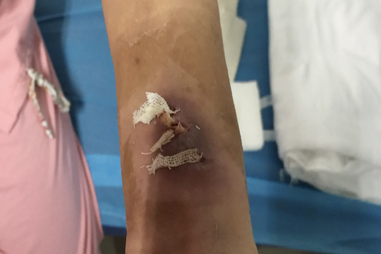 肌肉注射感染图