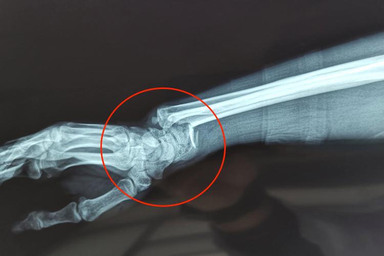 柯力氏骨折X线图 柯力氏骨折X线图