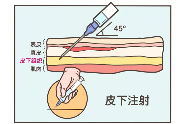 皮下注射角度图