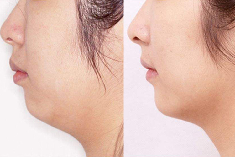 嘴突矫正前后对比图