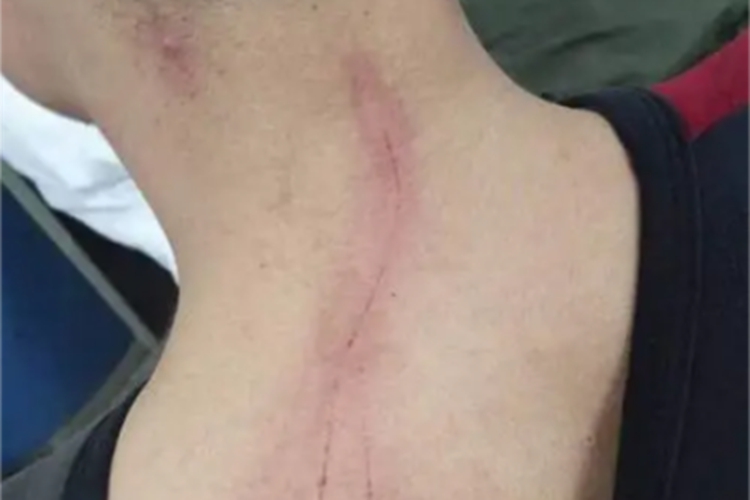 人工皮炎后颈疤痕图 人工皮炎后颈疤痕图