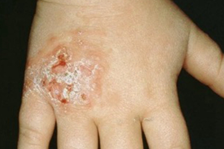 疣状皮肤结核手背症状图