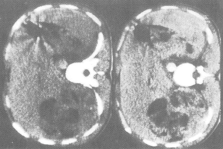 血管平滑肌瘤影像学表现图