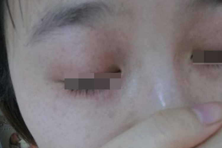 面粉过敏眼睛肿胀图 面粉过敏眼睛肿胀图