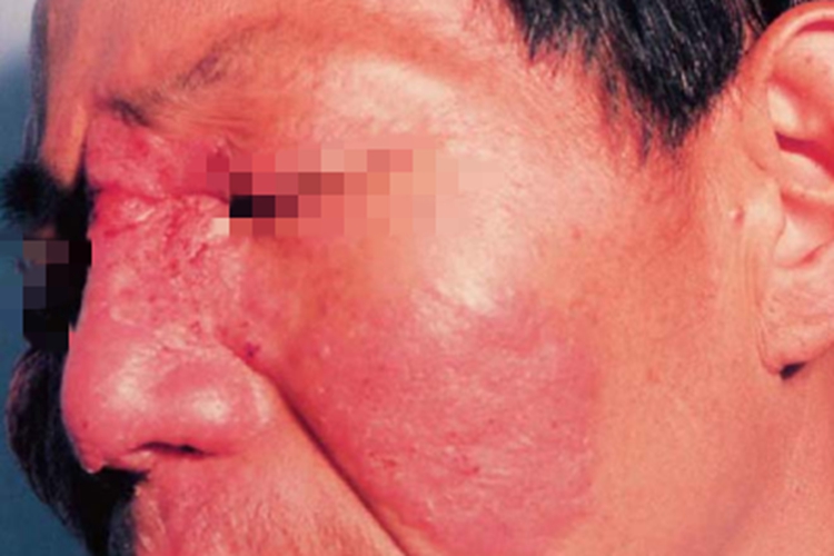 播散性镰刀菌病红斑图