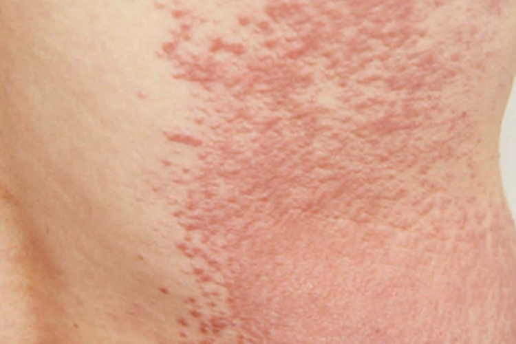 结节型黏液水肿性苔藓腰部结节图