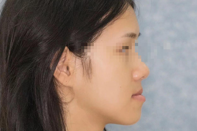 牙齿反颌图 牙齿反颌图