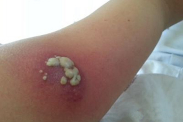 皮脂腺囊肿胳膊红斑图