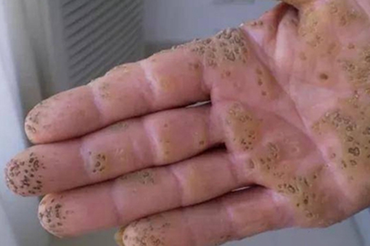 点状掌跖角化病手部症状图