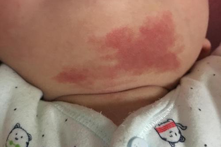 新生儿鲜红斑痣图