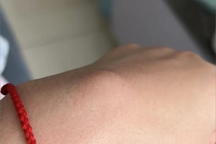 Ⅲ型痛性肥胖病手背症状图