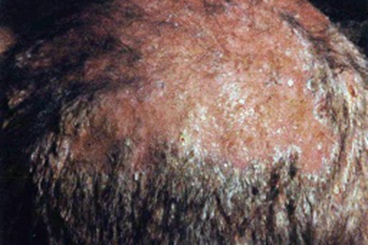 黄癣结痂并有萎缩性瘢痕图