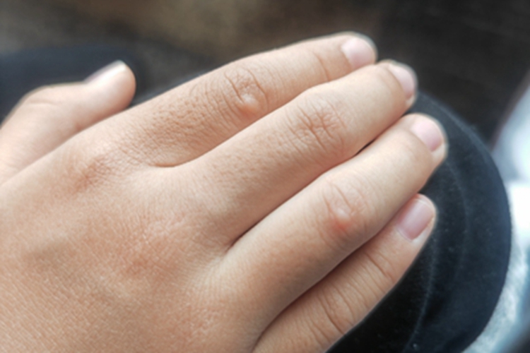 传染性软疣手指丘疹图