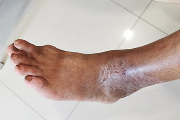 类风湿关节炎皮肤发黑图