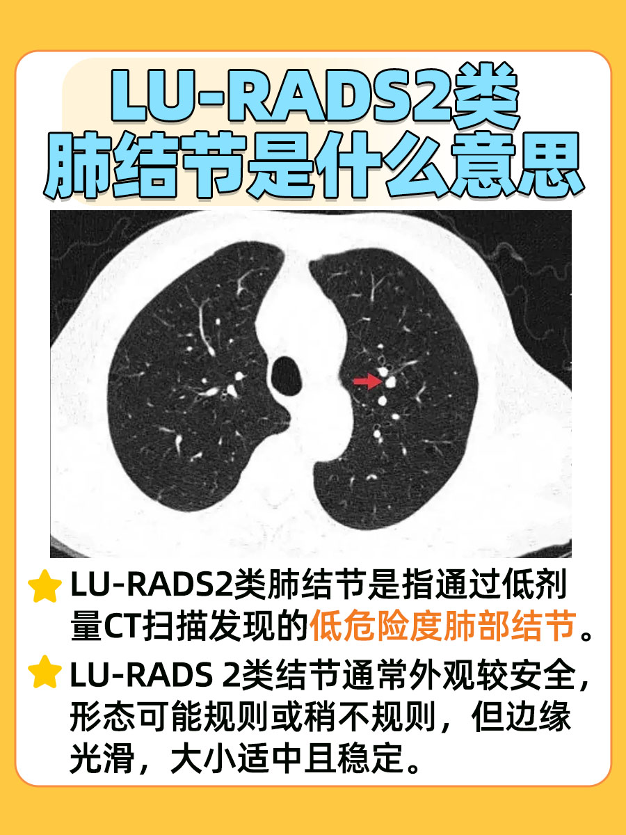 带你了解，LU-RADS2类肺结节是什么意思