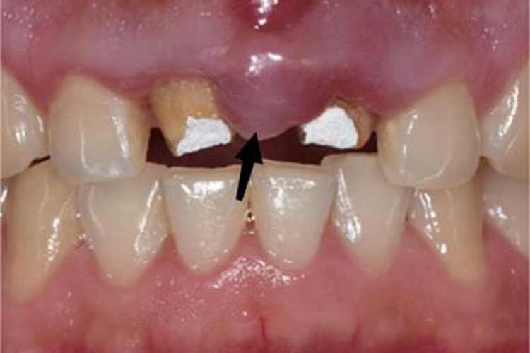 根尖周炎肿胀图