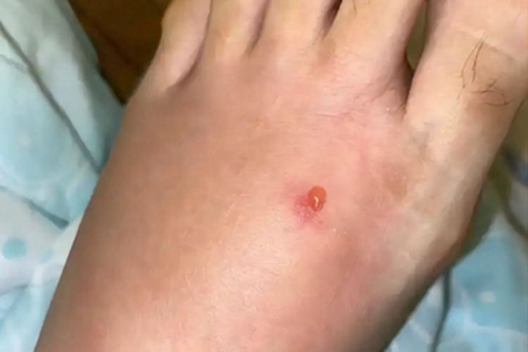 蚁蜇伤脚背红肿水疱图