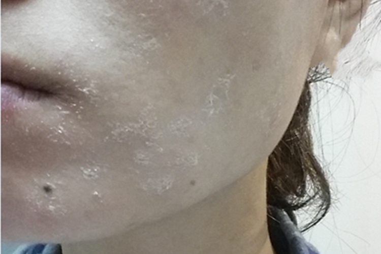 皮肤干燥症面部脱皮图 皮肤干燥症面部脱皮图