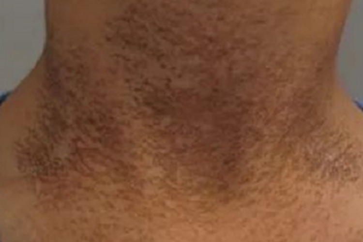 融合性网状乳头瘤病斑图