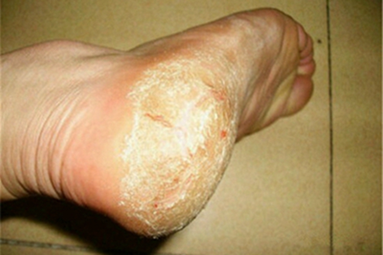 鱼鳞病脚后跟皲裂图