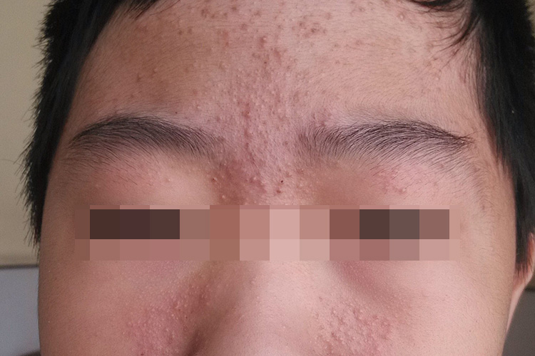 闭口粉刺图 闭口粉刺图