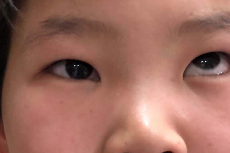 先天性左眼轻微内斜视图 先天性左眼轻微内斜视图